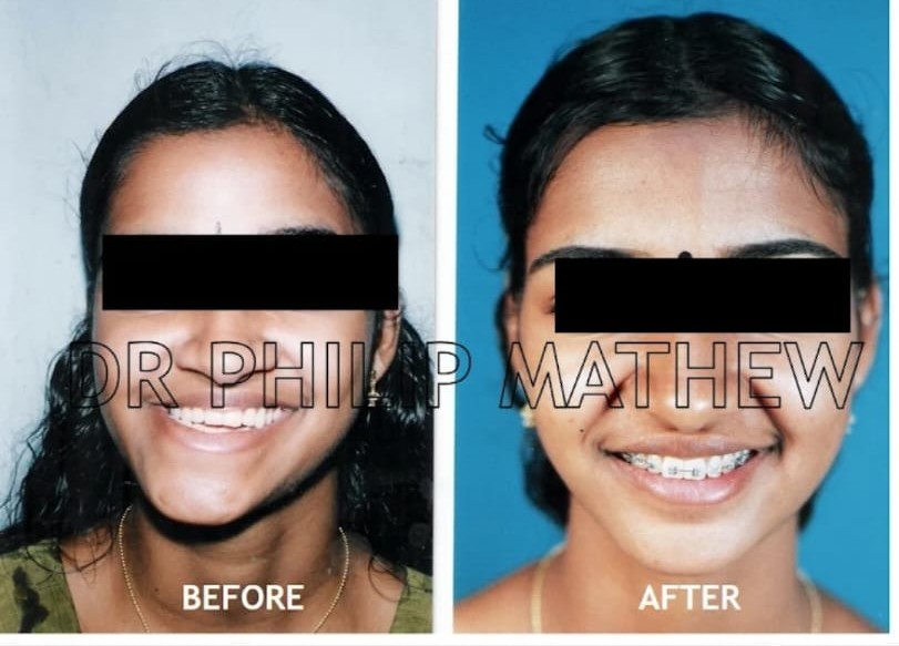 Facial Asymmetry Correction