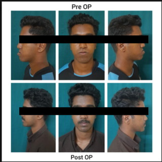 Cleft lip and Palate Treatment