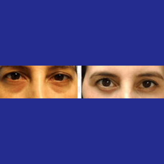 Oculoplastic Surgery