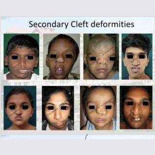 Cleft lip and Palate Treatment