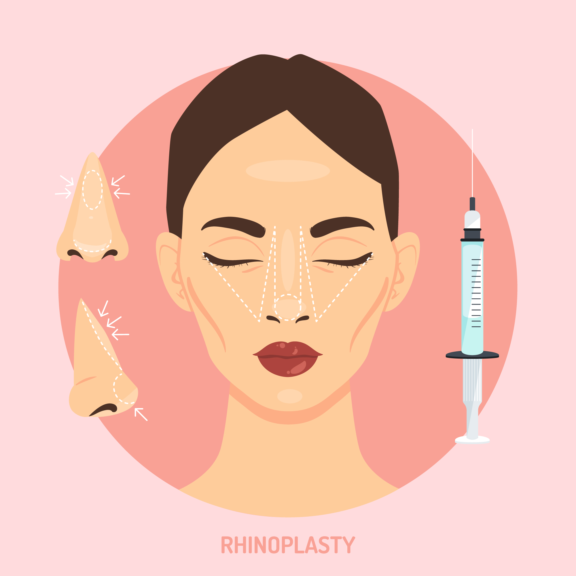 Rhinoplasty