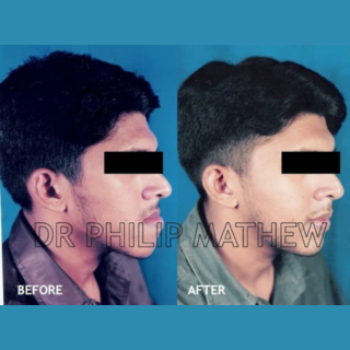 Facial Plastic Surgery