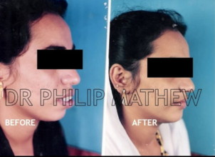 Orthognathic Surgery